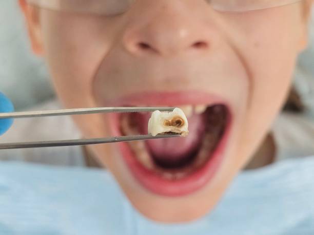 Best Dentist for Tooth Abscess  in Georgetown, GA